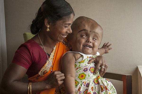 Γεννήθηκε υδροκέφαλο χειρουργήθηκε και σήμερα χαμογελάει!