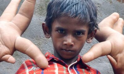 Ινδία: 8χρονο παιδί με χέρια γίγαντα