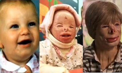 Δείτε πως η φωτιά παραμόρφωσε την 2χρονη Τerri Calvesbert | Παράξενες Ειδήσεις