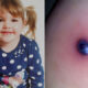 Το δάγκωμα ενός κουνουπιού έσωσε ένα τρίχρονο κοριτσάκι από τον καρκίνο | Παράξενες Ειδήσεις