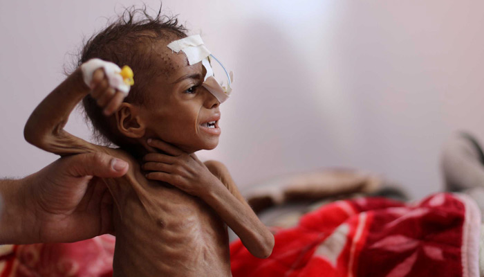 Υεμένη: Σε πρωτόγνωρα επίπεδα έχει φτάσει ο υποσιτισμός των παιδιών